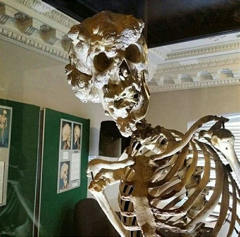 joe merrick|joseph merrick skeleton.